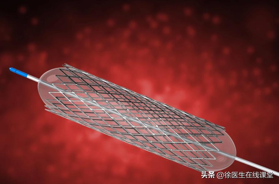 心脏三根血管都堵80%需要下支架吗,下了心脏支架血压低是什么问题