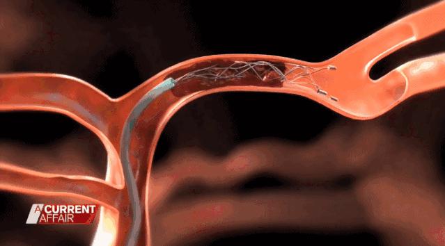 吃辣食物可以减肥吗,吃辣加速减肥