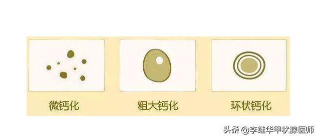 甲状腺结节钙化的严重吗能治好吗,甲状腺结节钙化有多少可能性癌变