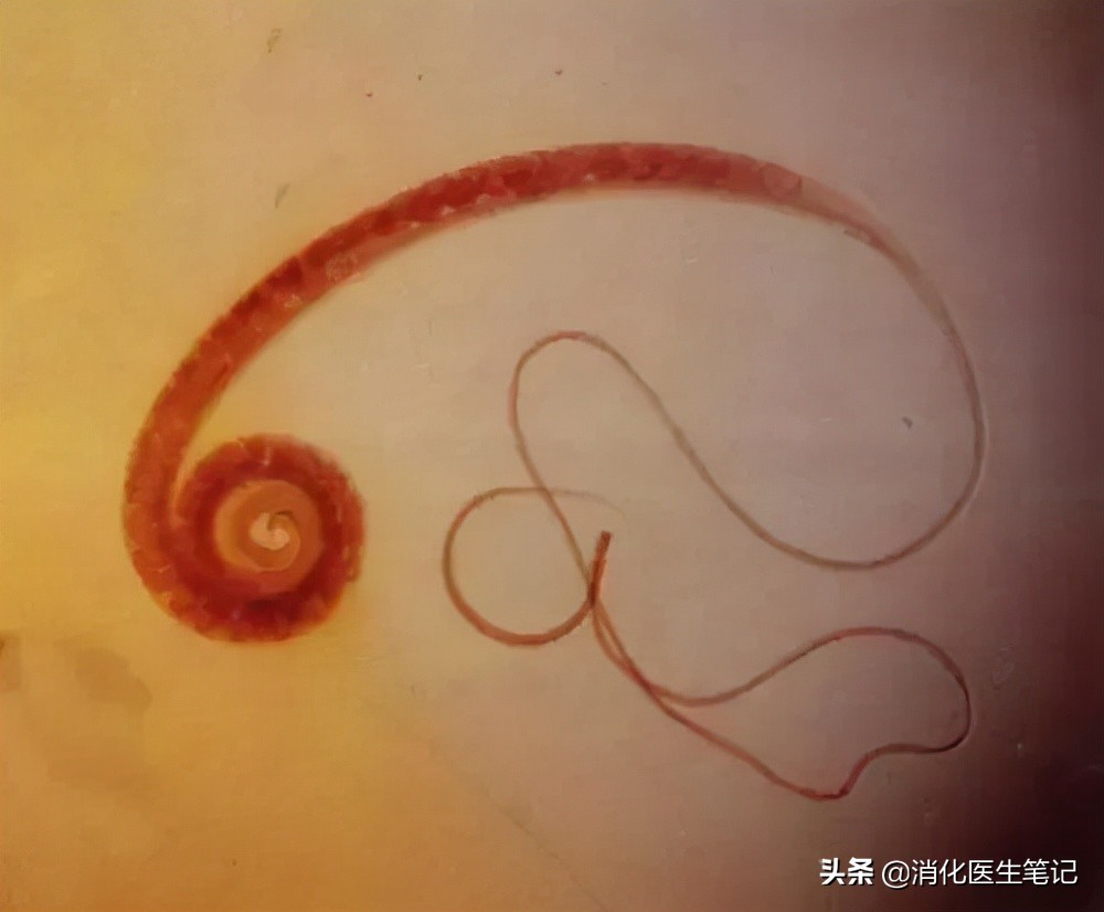 老年人肠胃镜检查,65岁老人胃肠镜检查