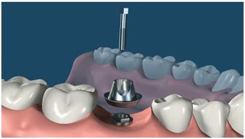 种植牙第二次手术痛苦吗,种植牙手术风险