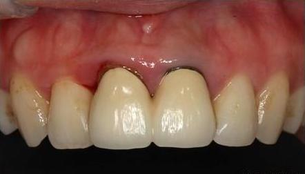 烤瓷牙安装后出现根尖周炎,烤瓷牙牙龈萎缩露黑边可以修复吗