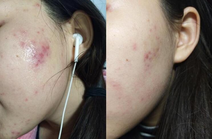 脸部螨虫多毛孔粗大,脸上螨虫毛孔粗大还能不能恢复