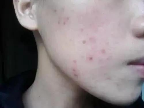 青春不在痘痘犹存,黑红痘印用什么方法可以最快去除
