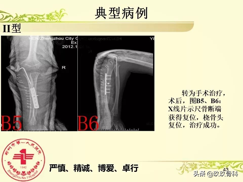 孟氏骨折功能训练多久能恢复正常,孟氏骨折中医能治吗