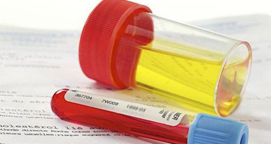 医生说我尿血买啥药治疗快,怀疑有血尿怎么办