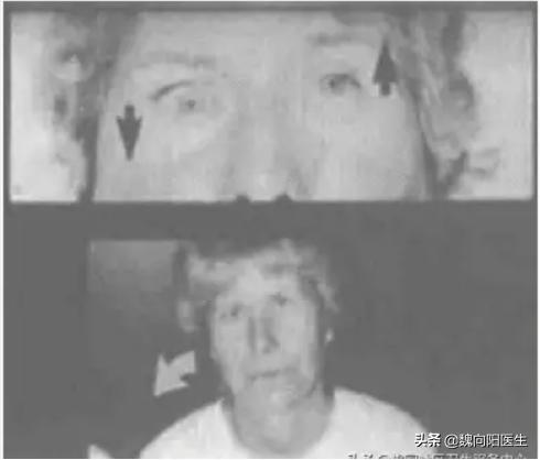 良性位置性眩晕鉴别,怎样判断眩晕是颈椎还是耳石症