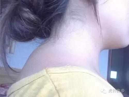 脖子后面鼓个包疼咋回事,脖子后面有结节说明颈椎病严重吗