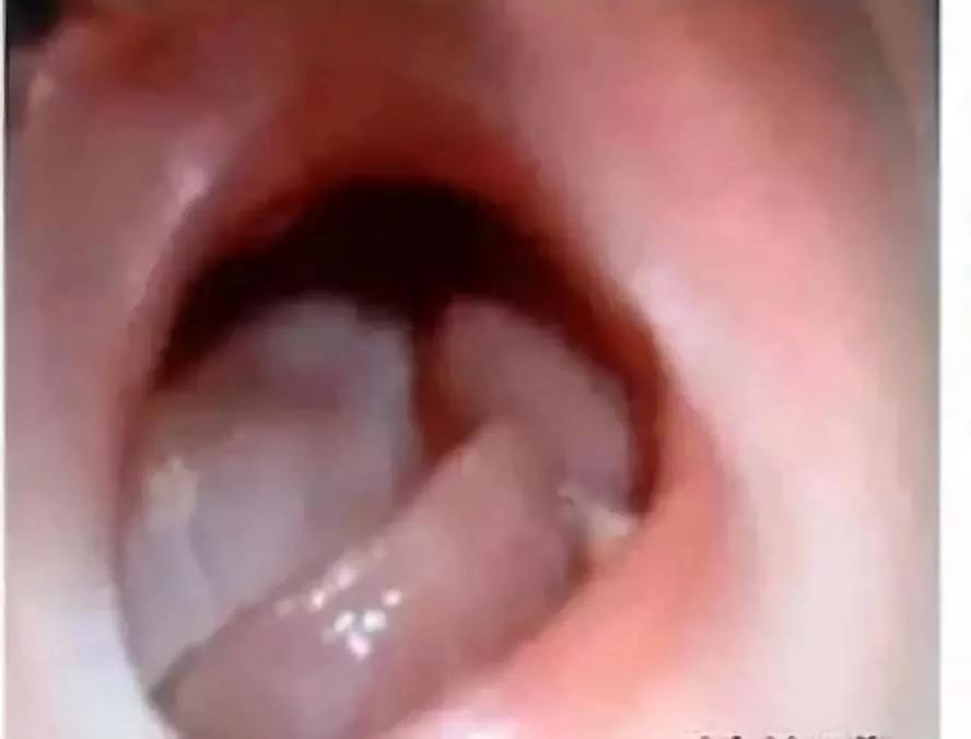 新生儿的几种生理现象图片,新生儿正常生理现象