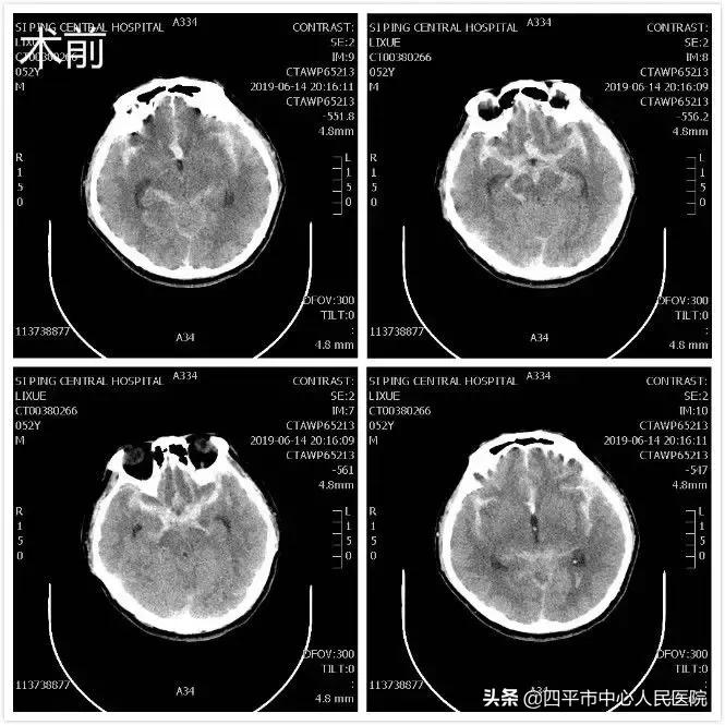 精准排雷再现新高—神经外科在6月份成功救治6例颅内动脉瘤患者