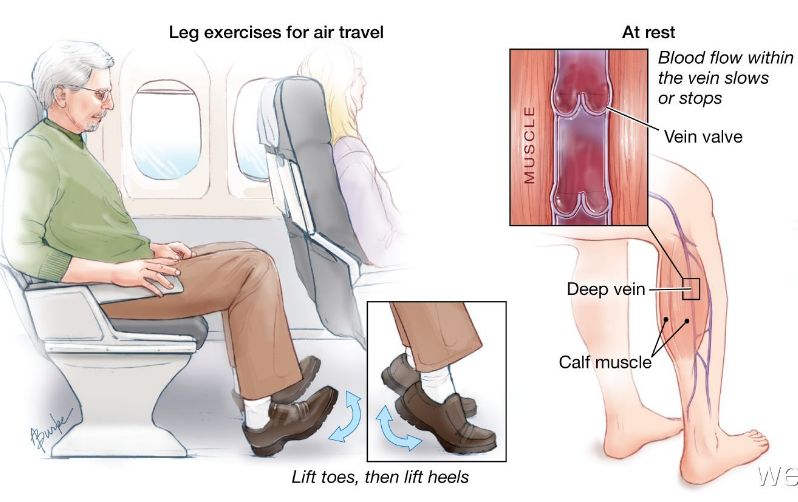 坐车时间长了第二天脚肿怎么处理,坐车时间长脚肿了怎么解决