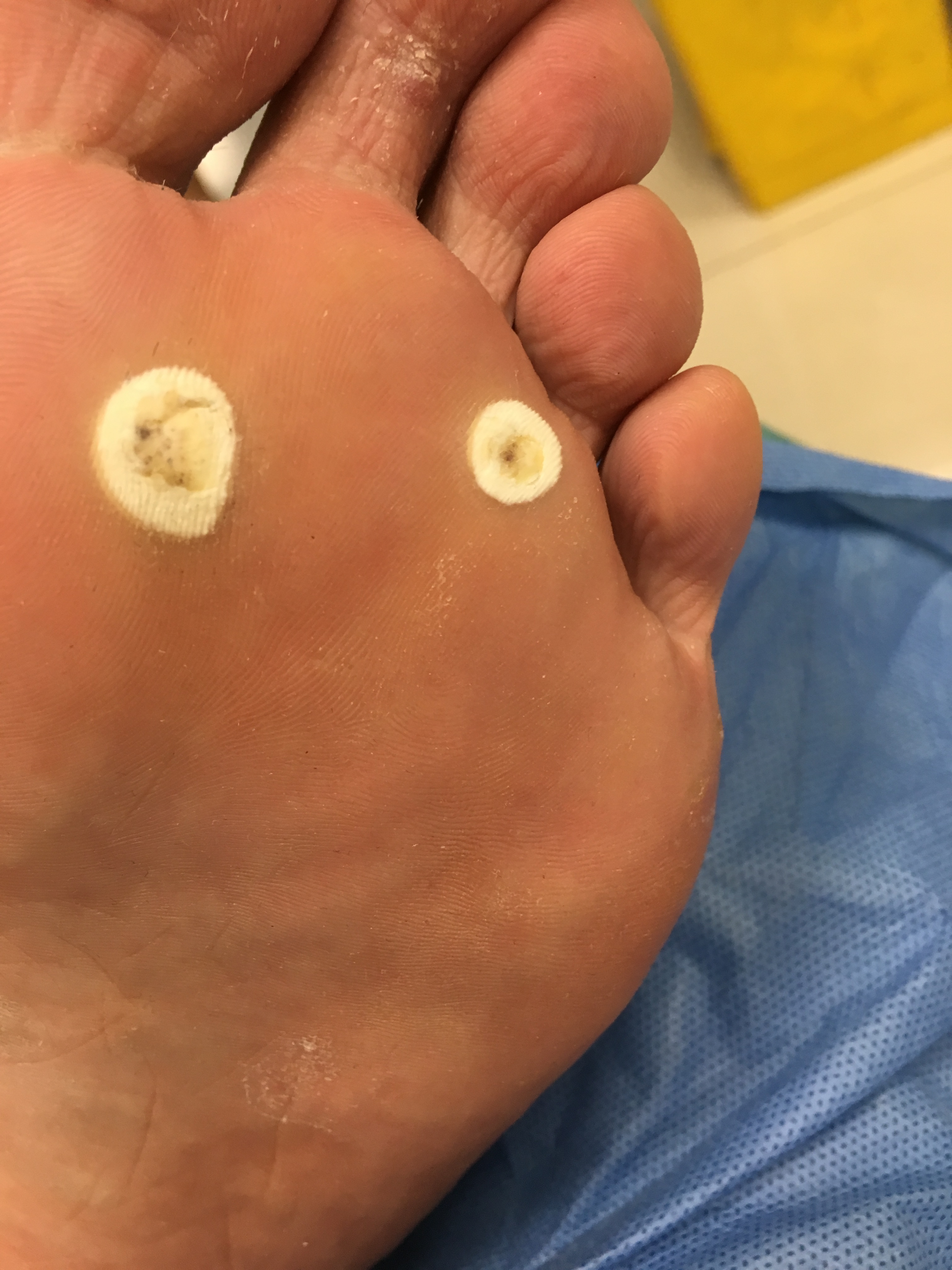 脚上长鸡眼是皮肤病吗,脚上起的是鸡眼还是疣