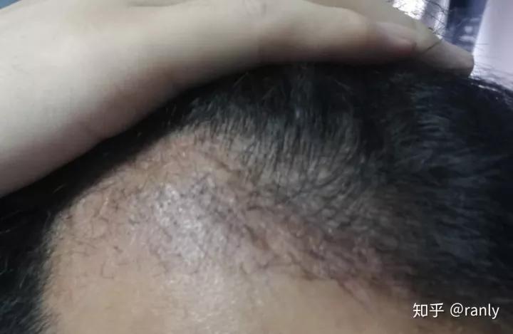 植发日记是什么,植发日记vlog第六天