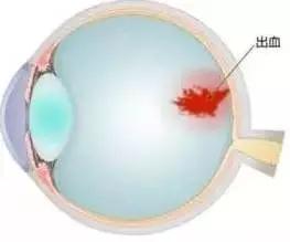 眼底出血是什么原因造成的怎么治,糖尿病眼底出血会发展成什么