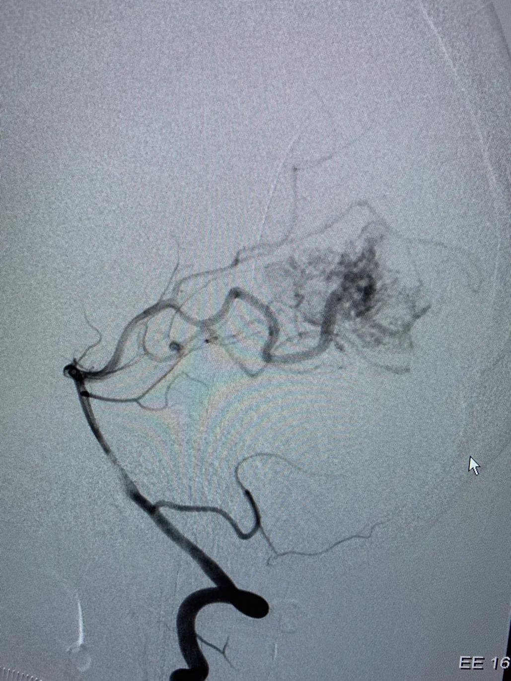 脑动静脉畸形介入栓塞手术的风险,介入栓塞技术在脑avm治疗中的作用
