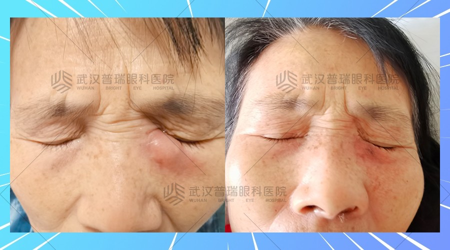 眼科泪囊堵塞,婆婆眼如何改善