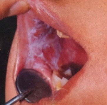 溃疡癌变有哪些症状,溃疡有一定的癌变几率