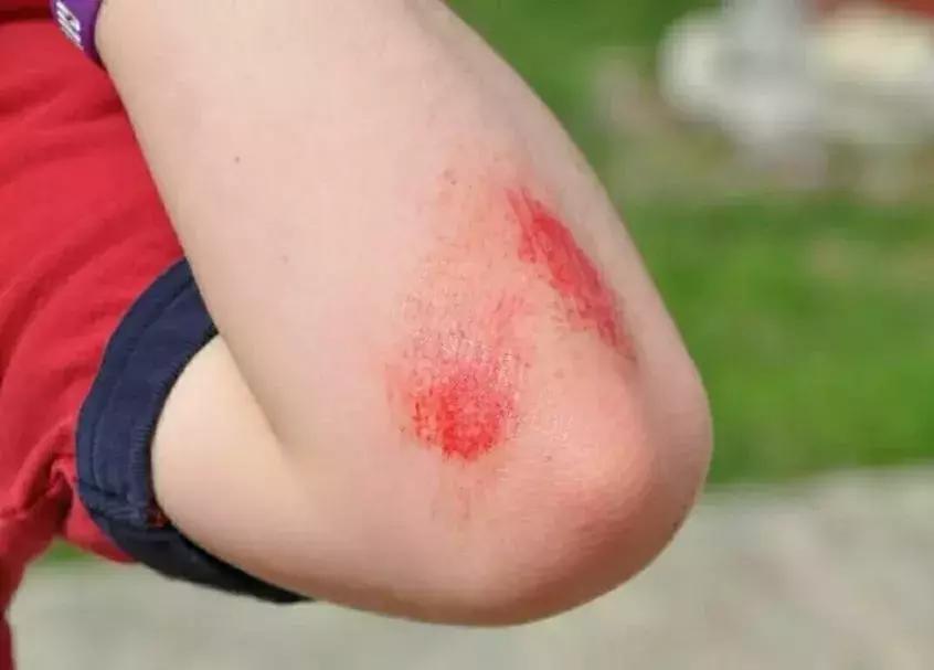 经常被烫伤割伤是犯了什么,烫烧伤怎么处理好得快