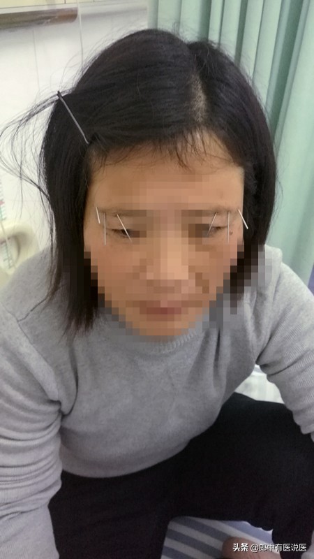 三叉神经痛剧烈疼痛怎么缓解,三叉神经痛治疗过程视频