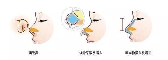 天生鼻型不完美怎么办呢,8种最丑鼻子合集