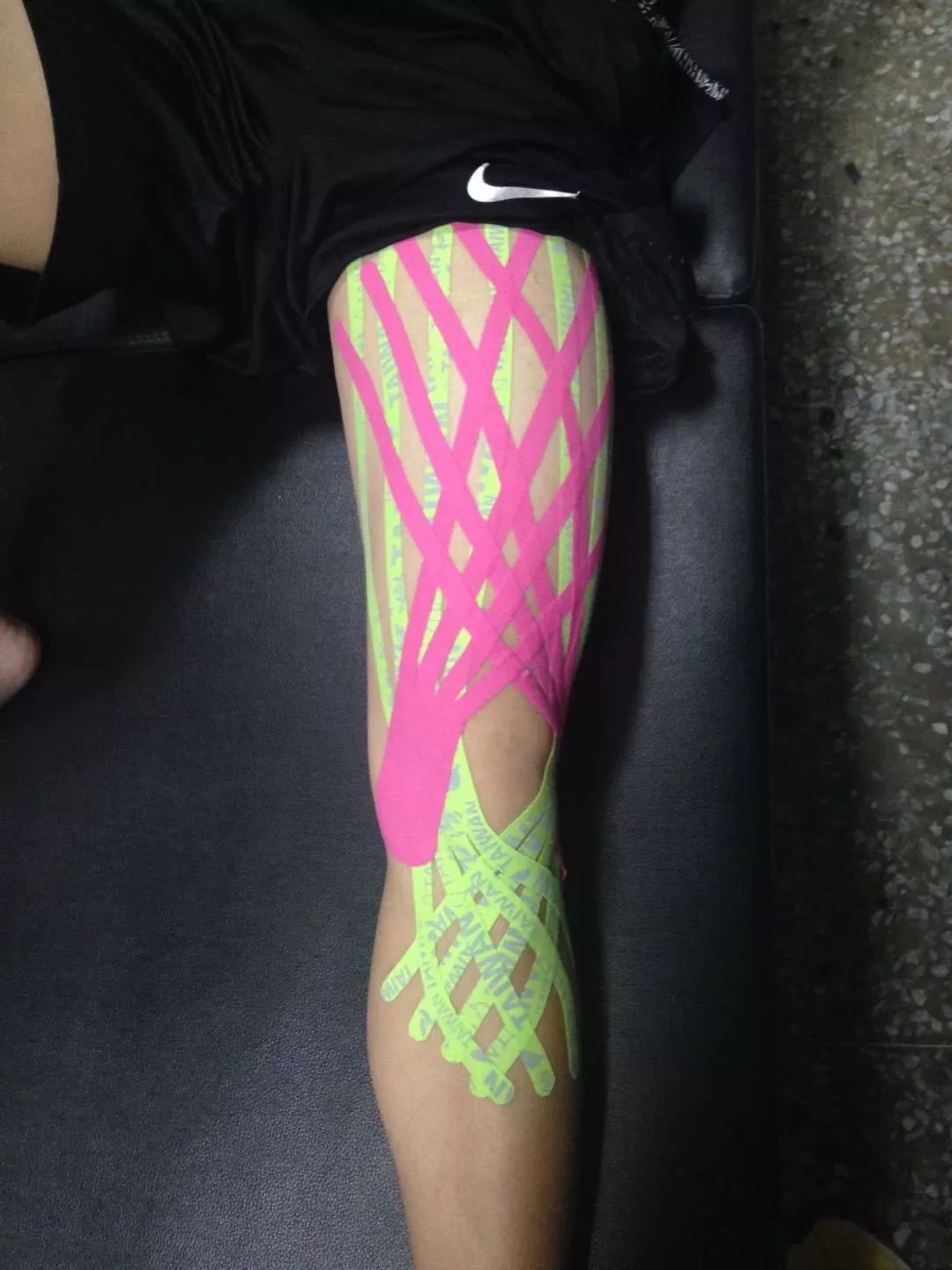 下肢骨折多长时间能消除肿胀,骨折手术后为什么脚垂下去会肿胀