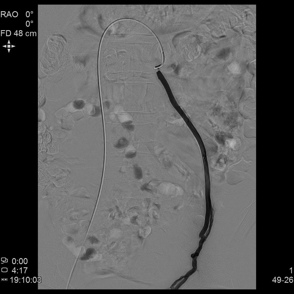 精索静脉曲张介入栓塞死路一条,精索曲张介入栓塞