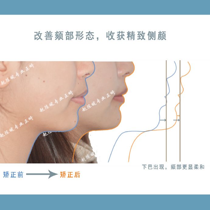 隐适美隐形矫正成功案例,经典隐形矫正