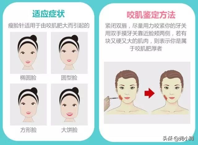 瘦脸针的科普,瘦脸针知识普及