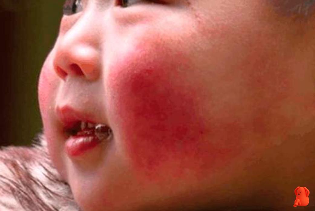 夏季宝宝脸蛋红并粗糙怎么样缓解,宝宝皮肤薄怎么改善