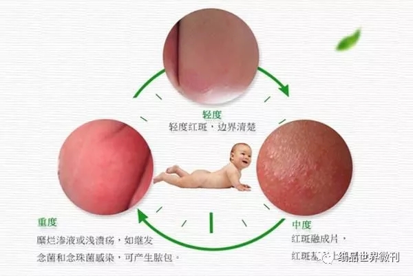 宝宝屁股红是纸尿裤的问题吗,宝宝屁股红是纸尿裤导致的吗