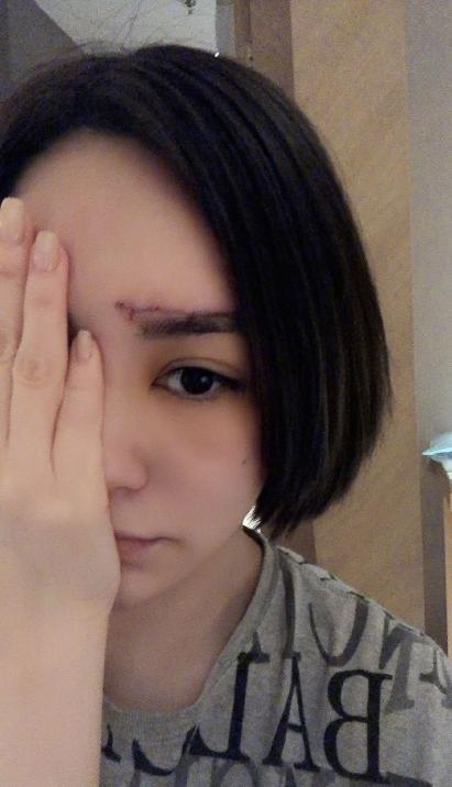 医美专家爆阿娇6㎝伤口肯定留疤痕,激光也难以恢复平滑肌肤