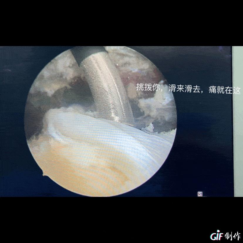 膝关节松解术松解髌骨吗,膝关节松解手术的效果