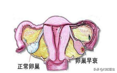 27岁卵巢功能早衰,27岁卵巢早衰50岁会怎么样