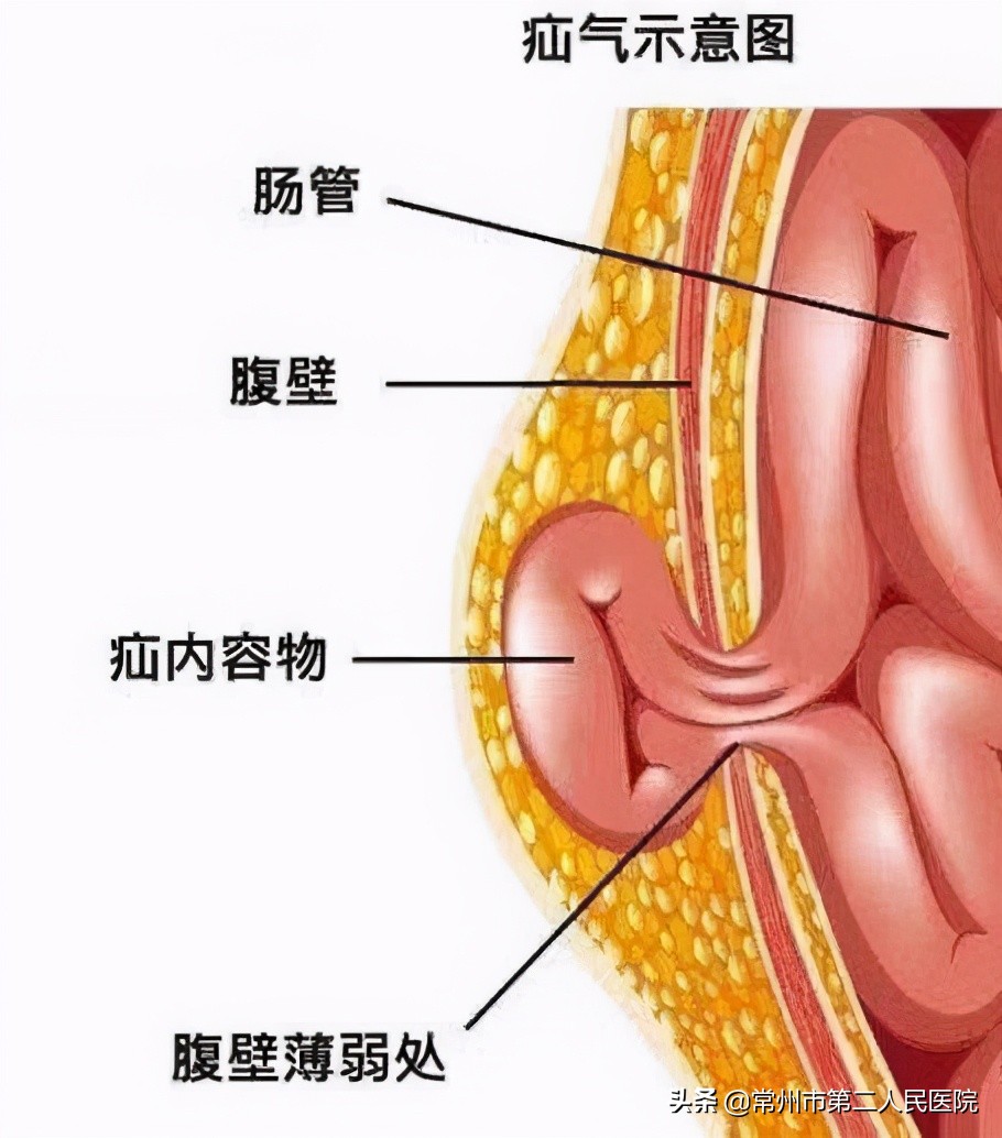 常州二院疝外科手术量,常州二院腹壁疝专家