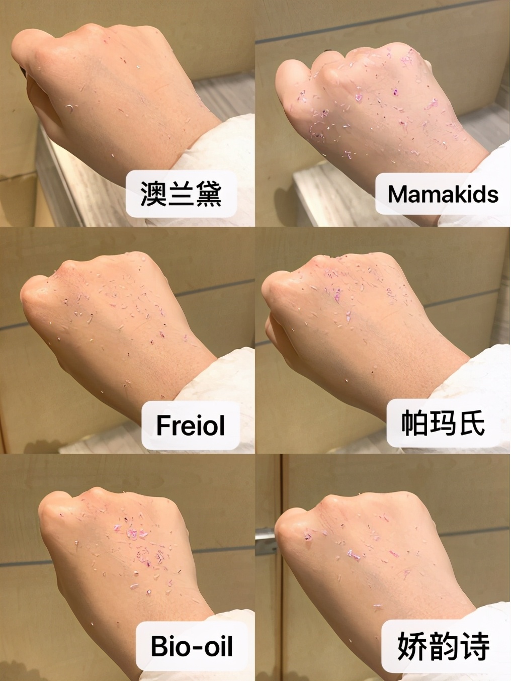 如何预防妊娠纹和消除妊娠纹,如何预防产后妊娠纹