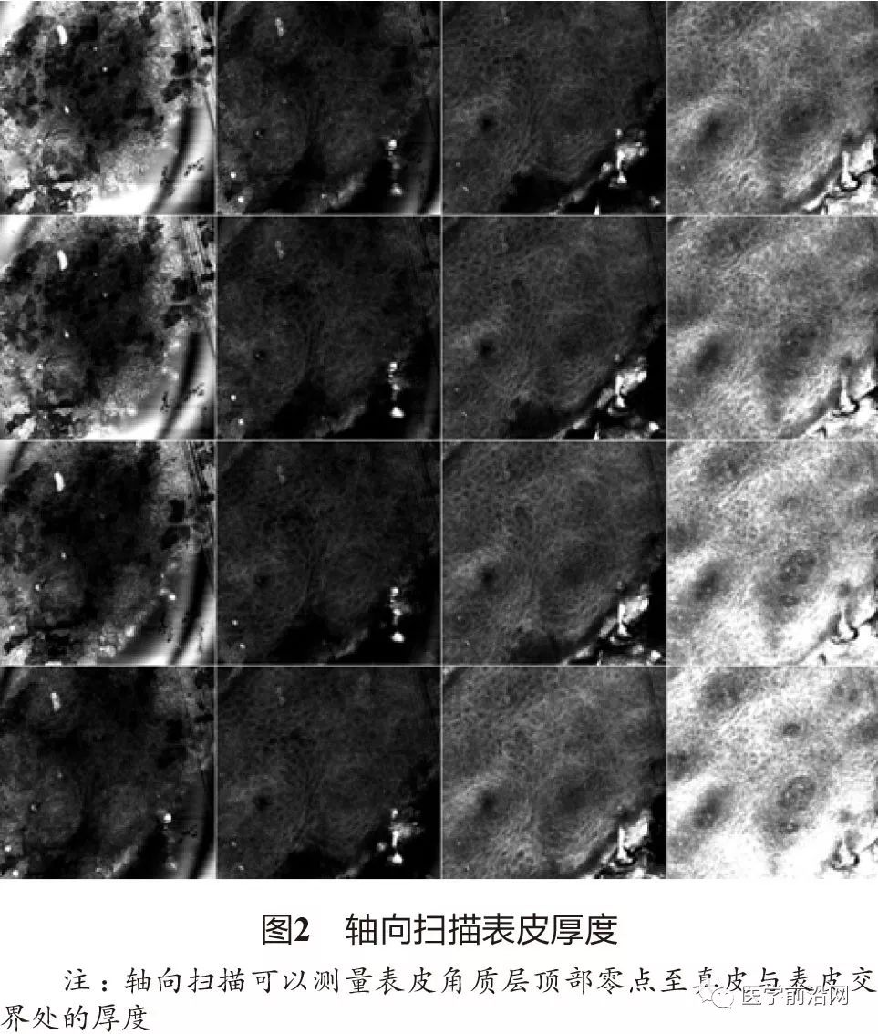 炎症性皮肤病反射式共聚焦显微镜诊断特征专家共识全文发布