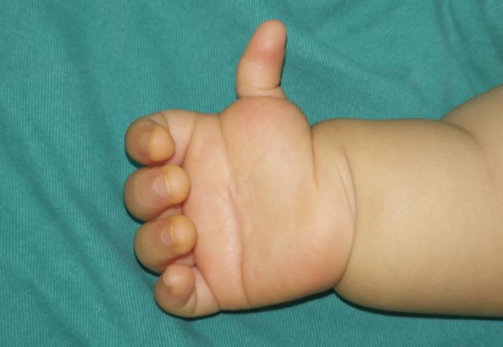 拇指多指手术后怎么护理,拇指漂浮指治疗康复案例