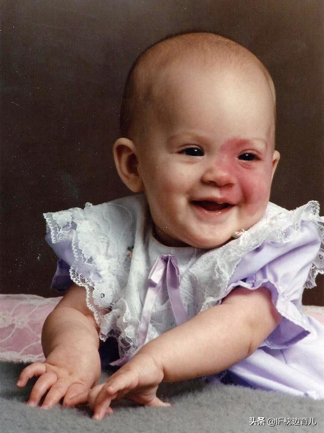 新生儿宝宝胎记,新生儿宝宝脸上的胎记能治吗