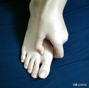 拇外翻大脚趾疼如何在家就能治,如何判断拇外翻造成的脚疼