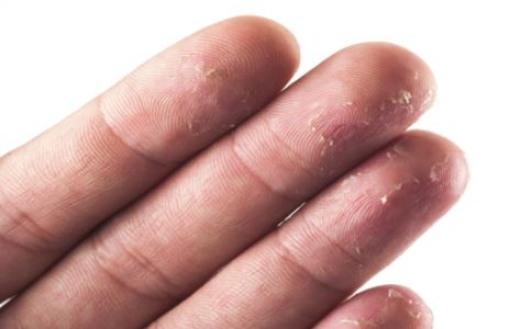 手掌痒脱皮硬皮开裂什么原因,手掌脱皮是什么原因引起的