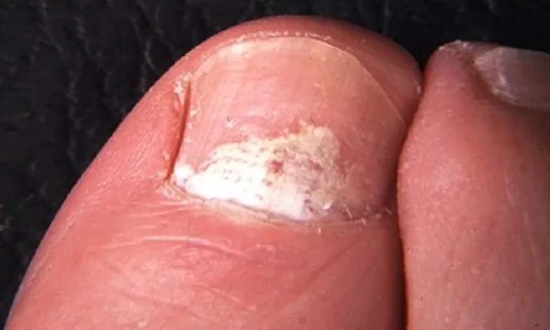 灰指甲伊曲康唑怎样用,灰指甲交叉感染怎么防治