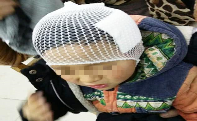 女儿摔倒头磕了一个大包,小朋友摔倒额头磕个大包要紧嘛