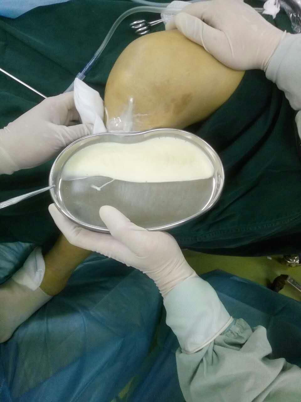 膝盖积水以后是热敷还是冷敷？真能解决问题吗？医生：可能都没用