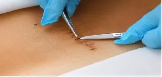 包皮术后多久拆线,术后拆线后要注意些什么