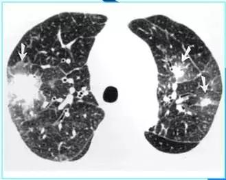 肺部ct十大征象,肺部ct正常图和异常图的区别