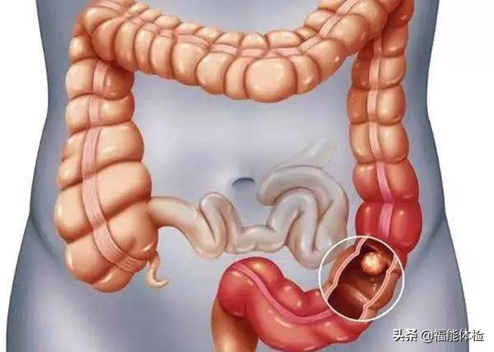 肠息肉切除后多久复查一次肠镜,肠息肉切除后多久复查一次