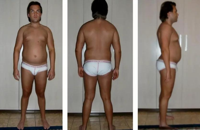 “真人肯尼”痴迷整容多年后，最终将自己整成了女人