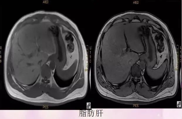 核磁共振能看出来哪些病症,核磁共振可以检查良恶性吗