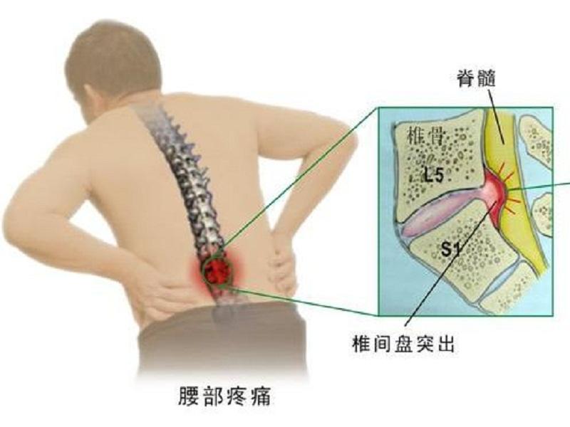 腰椎间盘膨出突出脱出有区别吗,腰椎间盘膨出和突出的中医治疗