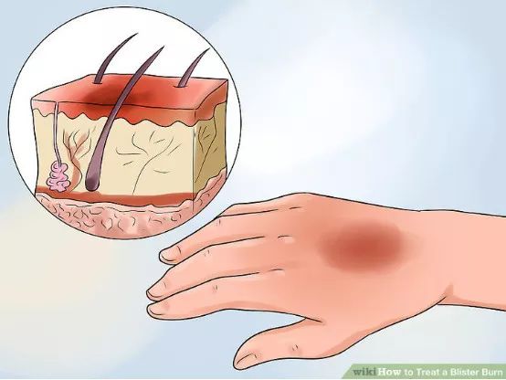 怎么预防跑步起水泡,一到夏天跑步脚就起泡怎么办